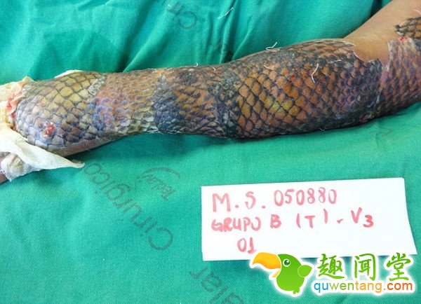女子手臂烧伤后植入鱼皮有弹性 竟有如此神效!