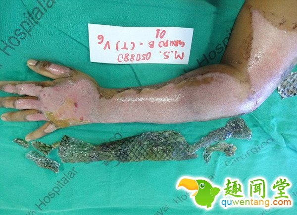 女子手臂烧伤后植入鱼皮有弹性 竟有如此神效!